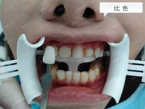 牙齿浮雕什么意思（牙齿6d浮雕）-图3